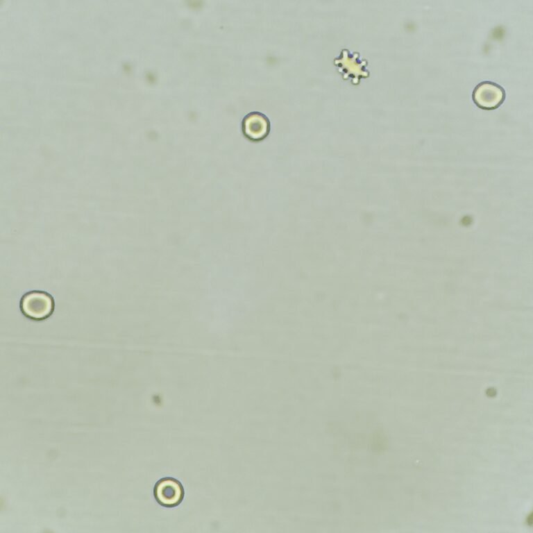 Bizzare Rbcs RBCs in Urine & Their Lookalikes - MedLabBuddy