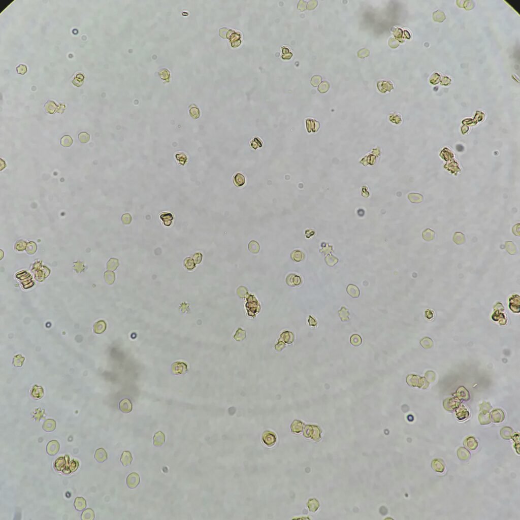 red blood cells in urine