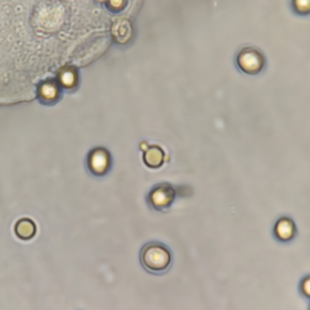 RBCs in Urine, Dysmorphic