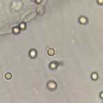 Eumorphic Rbc RBCs in Urine & Their Lookalikes - MedLabBuddy