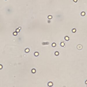 Bizzare Rbcs RBCs in Urine & Their Lookalikes - MedLabBuddy