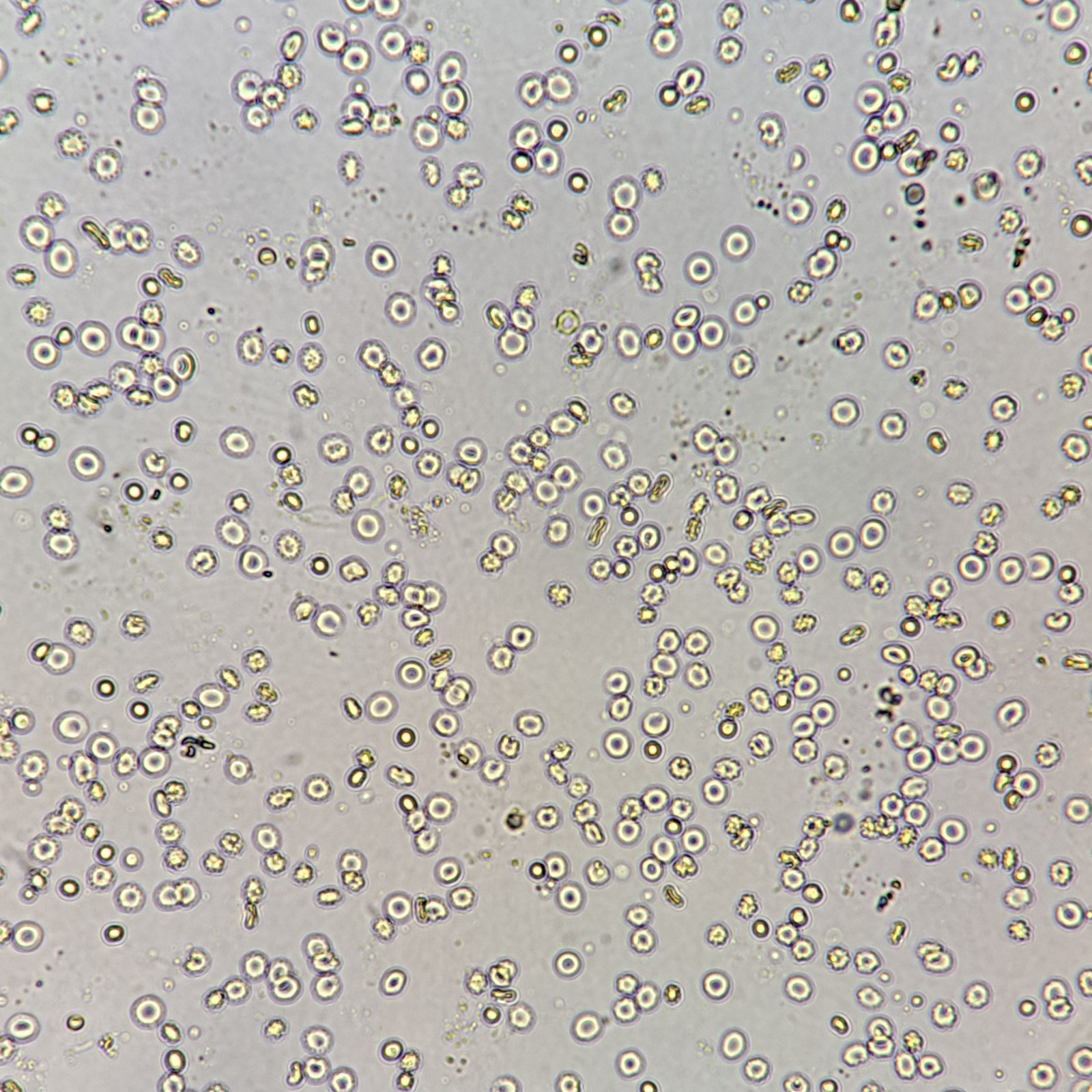 red blood cells in urine