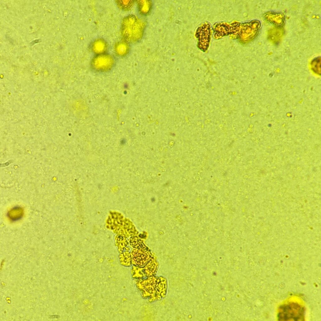 Renal tubular epithelial cell casts in icteric urine sediment