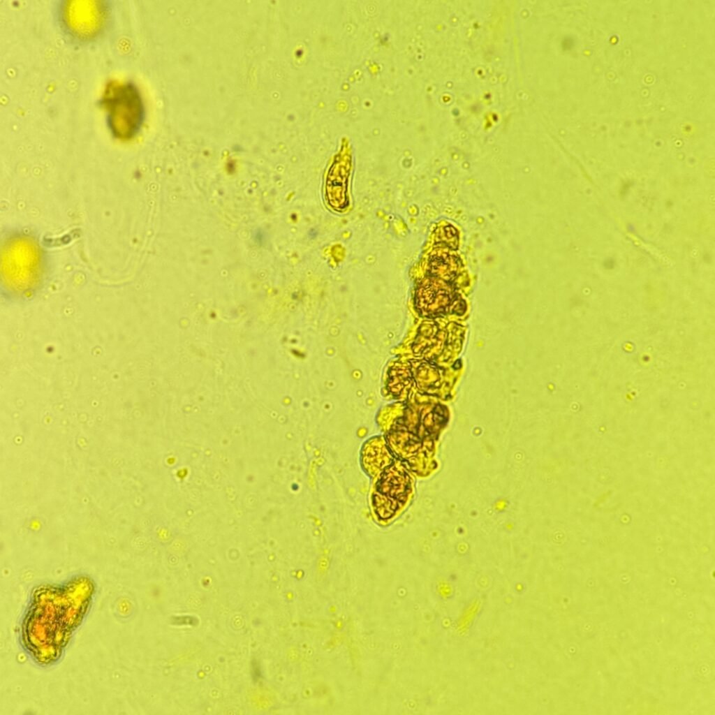 Renal tubular epithelial cell casts in icteric urine sediment