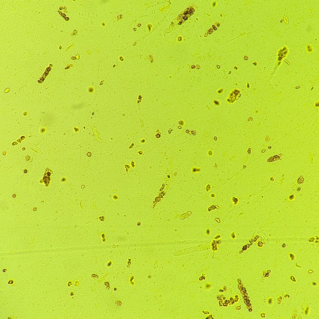 Renal tubular epithelial cell casts in icteric urine sediment