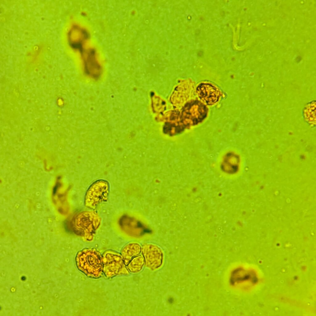 Renal tubular epithelial cell casts in icteric urine sediment