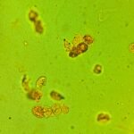 Renal Tubular Epithelial Cell Casts: Identification & Significance ...