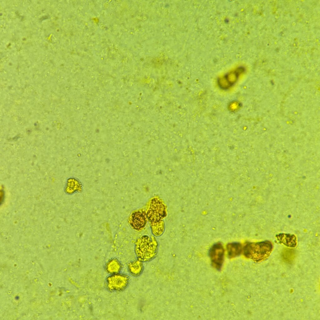 Renal tubular epithelial cell casts in icteric urine sediment