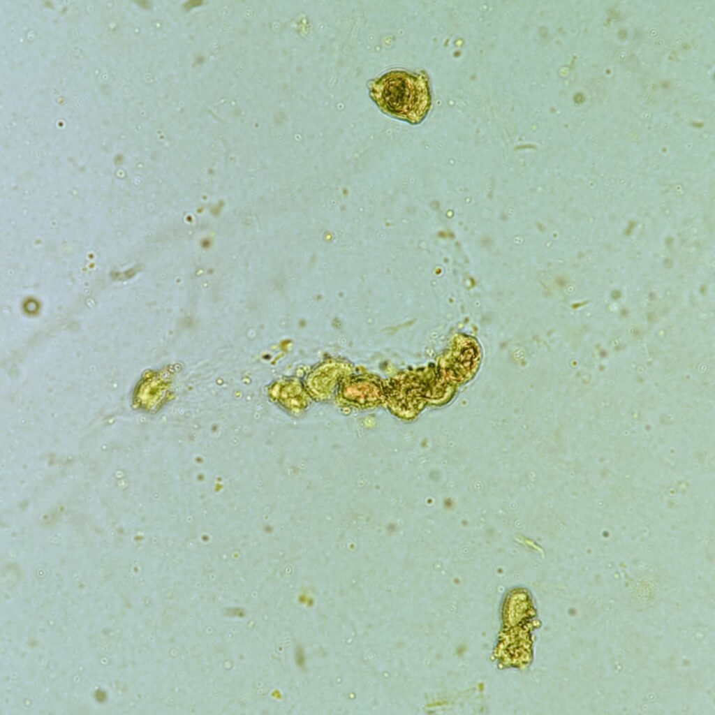 Renal tubular epithelial cell casts in icteric urine sediment