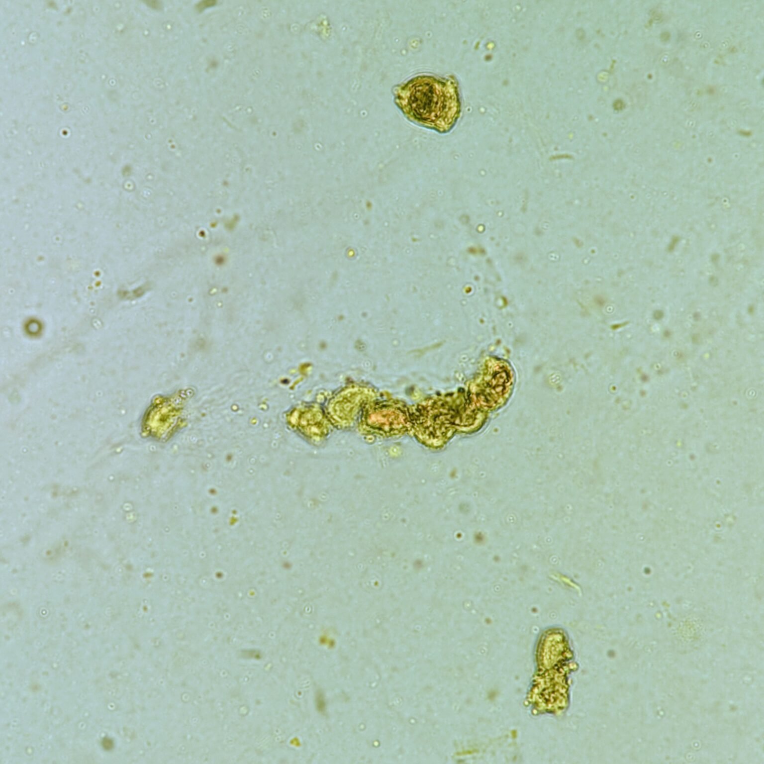 Renal Tubular Epithelial Cell Casts: Identification & Significance ...
