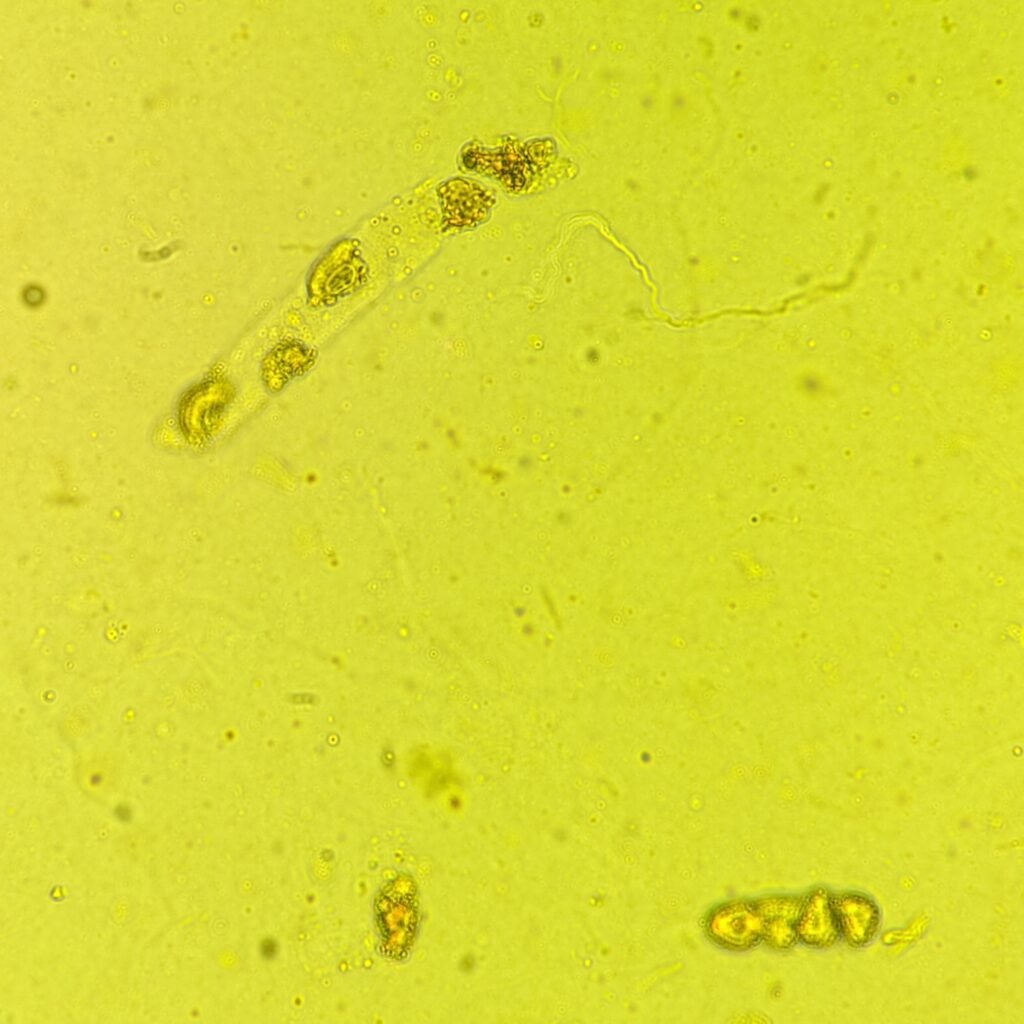 Renal tubular epithelial cell casts in icteric urine sediment