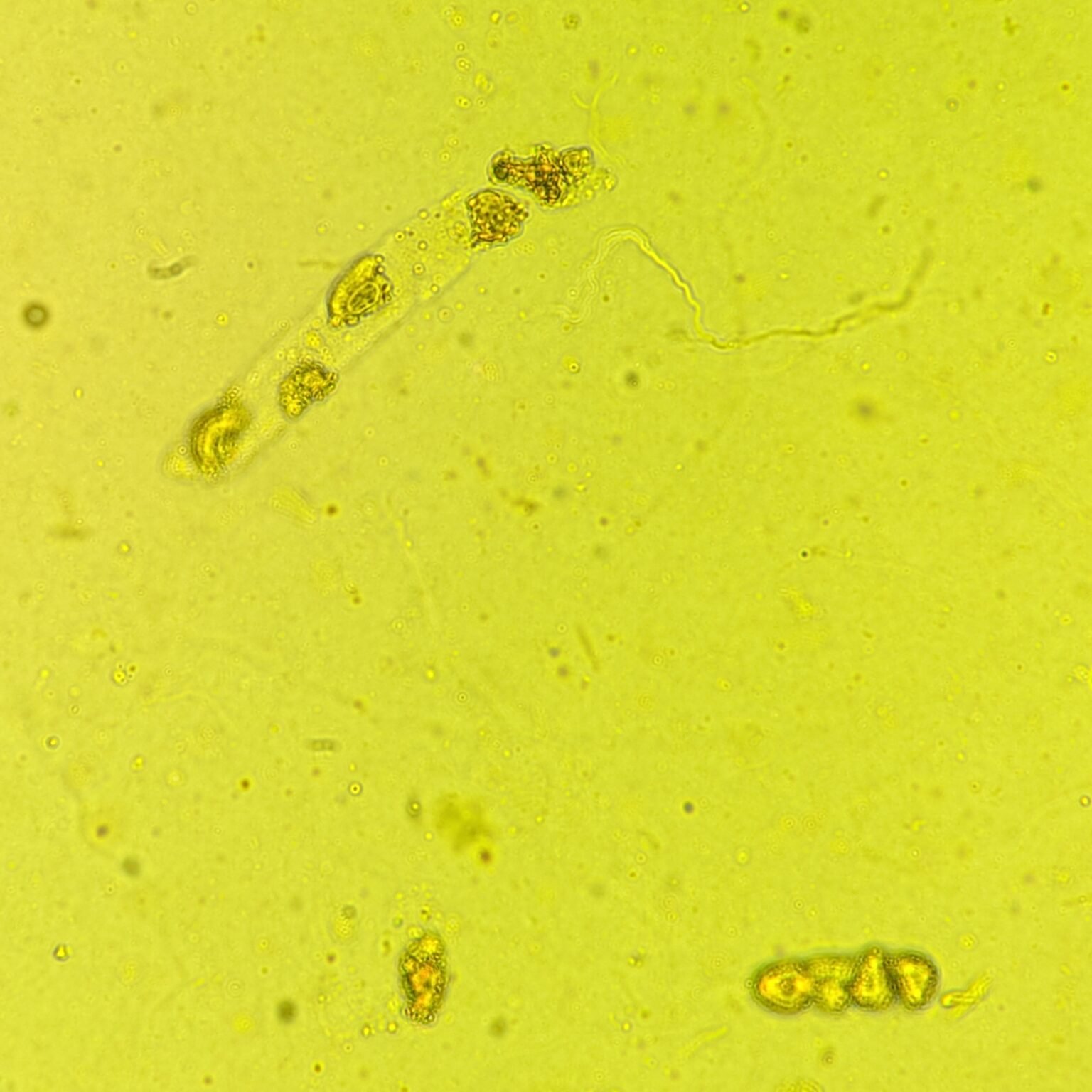Renal Tubular Epithelial Cell Casts: Identification & Significance ...