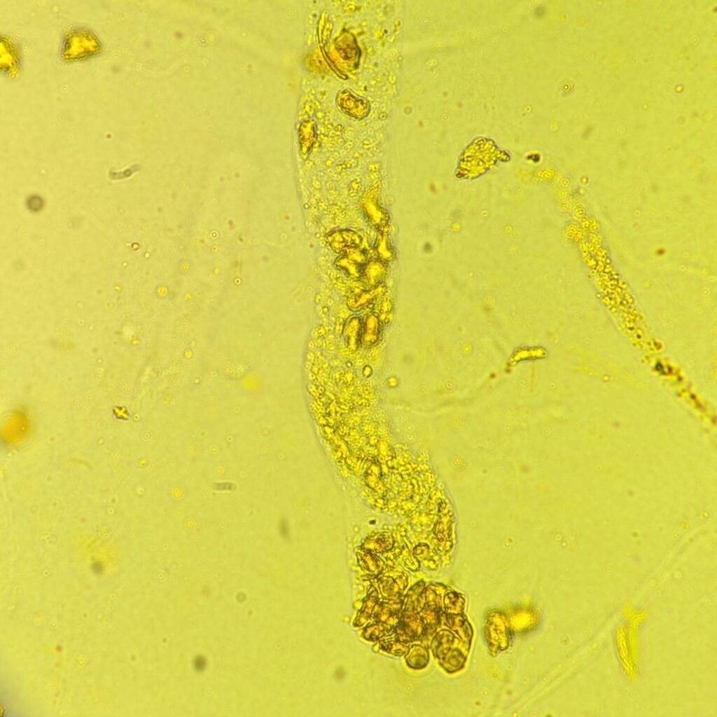 Renal tubular epithelial cell casts in icteric urine sediment