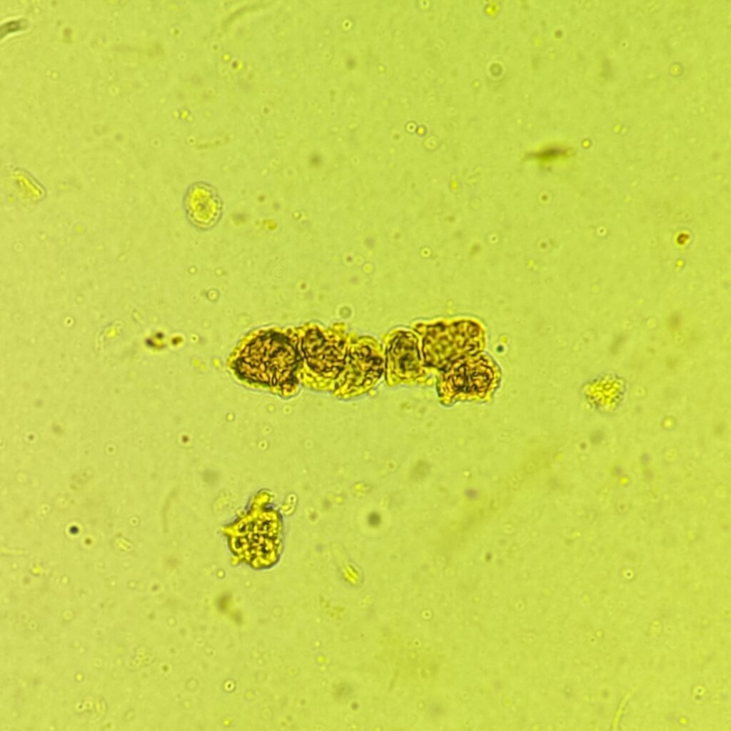 Renal tubular epithelial cell casts in icteric urine sediment