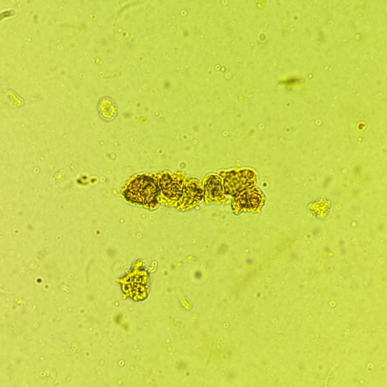 Renal Tubular Epithelial Cell Casts: Identification & Significance ...