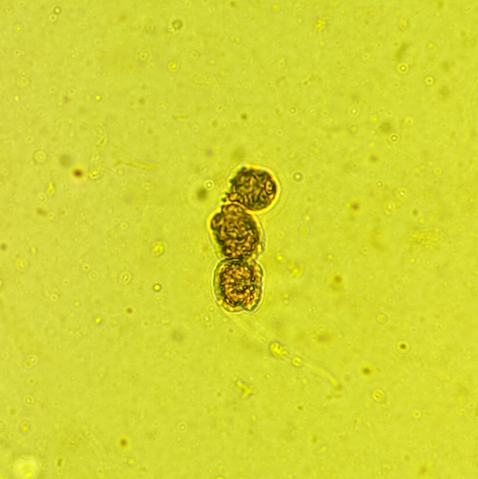 Renal tubular epithelial cell casts in icteric urine sediment