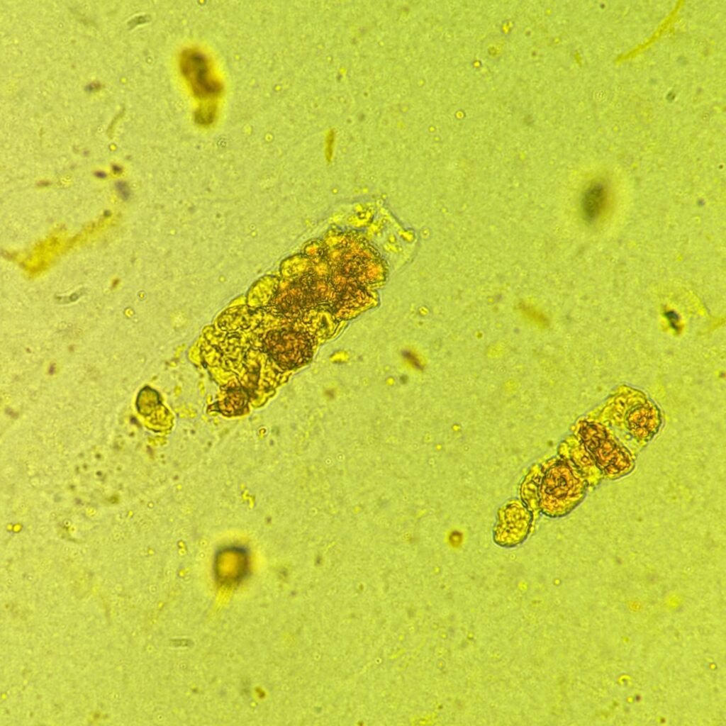Renal tubular epithelial cell casts in icteric urine sediment