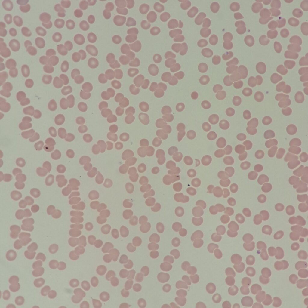 RBC morphology showing rouleaux