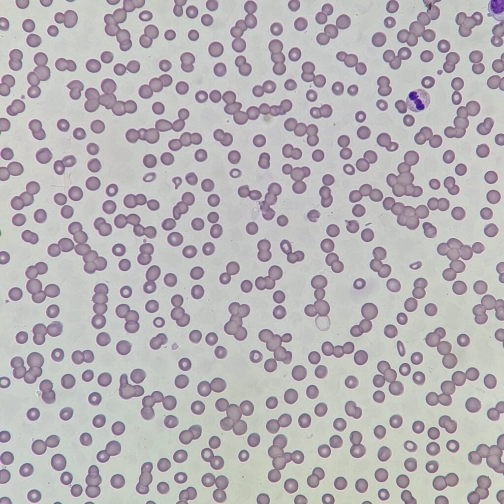 Rouleaux, red blood cell morphology