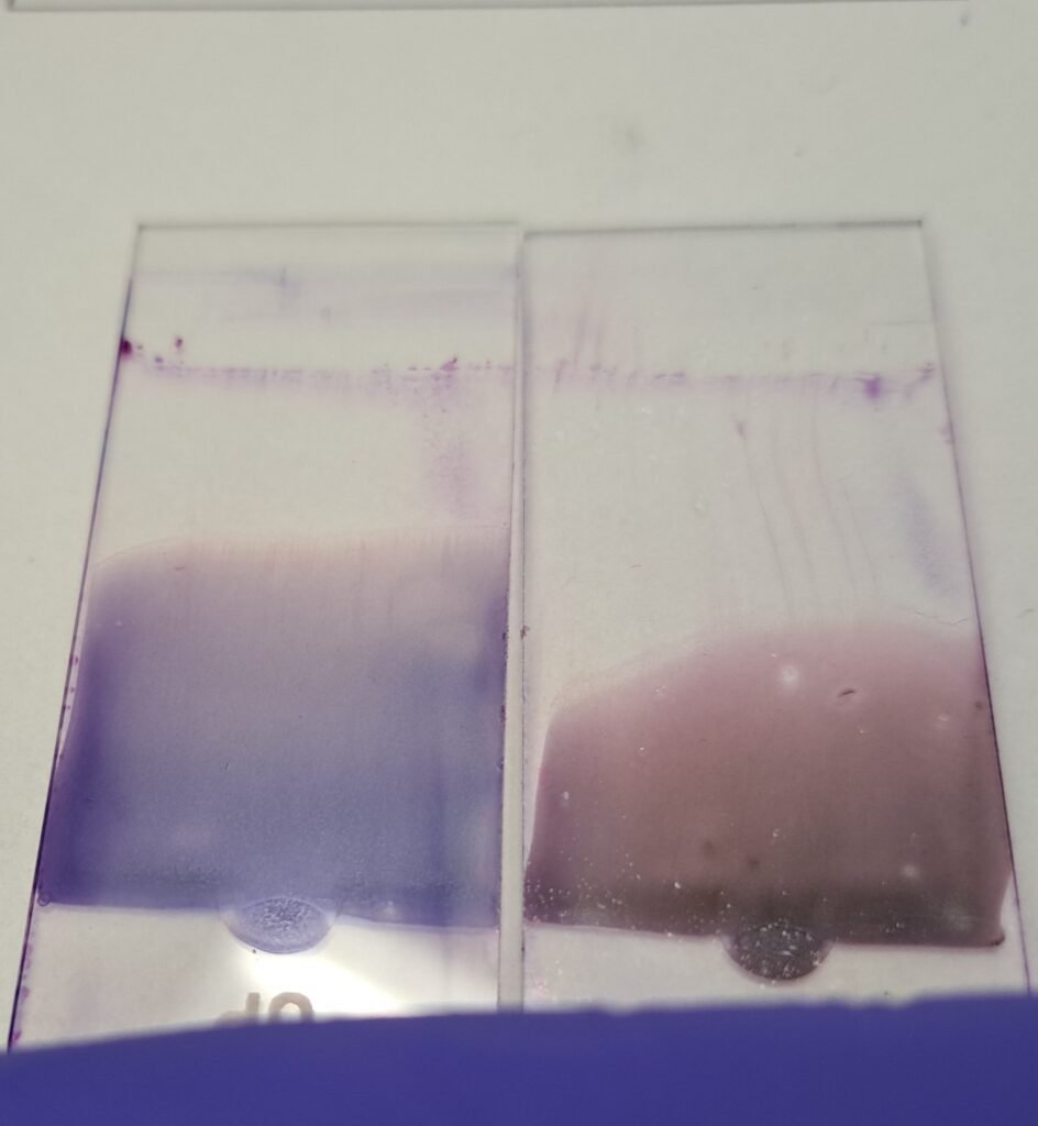 Two blood smears on slides. One is more blue from excess proteins as seen in Multiple Myeloma.