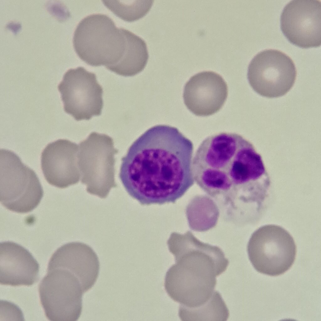 A type of nucleated red blood cell: Polychromatophilic Normoblast (Rubricyte)