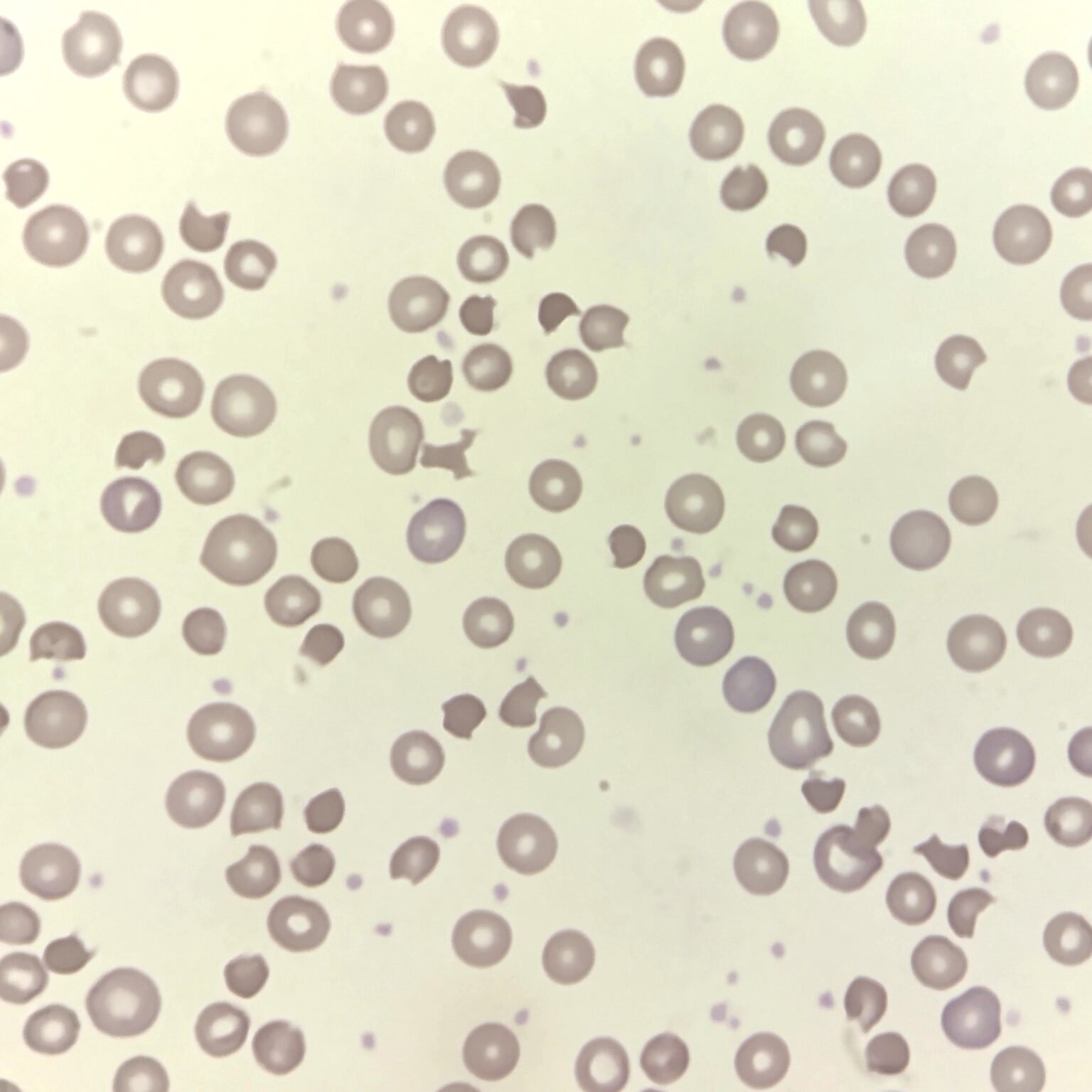 RBC Morphology Based on Shape