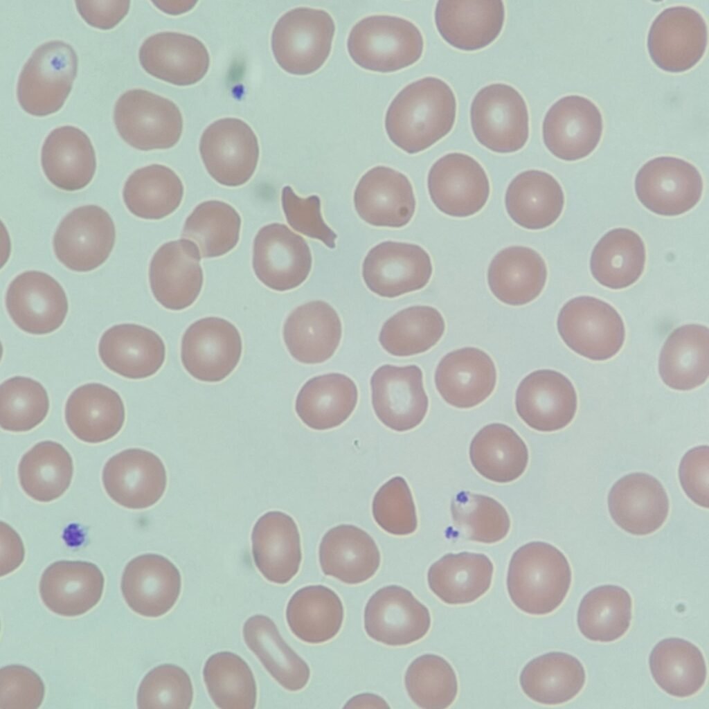 Schistocytes, red blood cell morphology