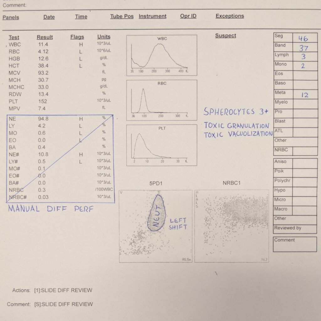 complete blood count of patient with severe sepsis & intravascular hemolysis
