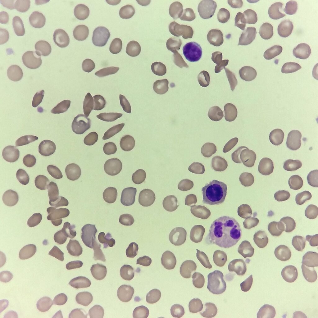 Sickle Cells (Drepanocytes)