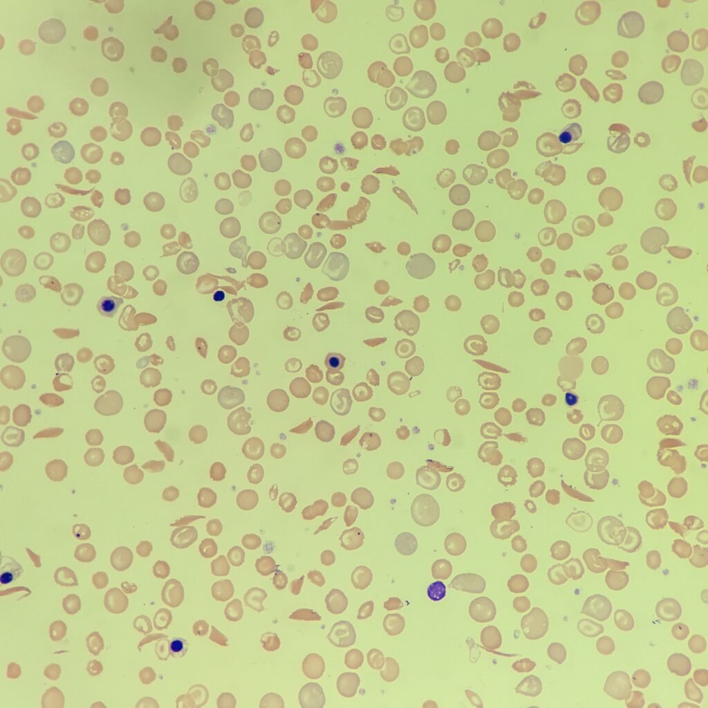 Sickle Cells, nucleated red blood cells, red blood cell morphology
