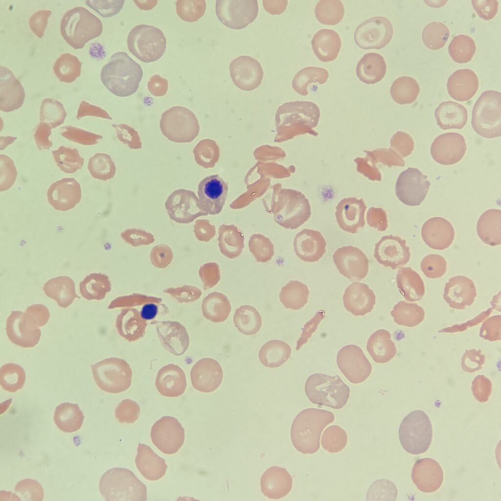 Sickle Cells, nucleated red blood cells, red blood cell morphology