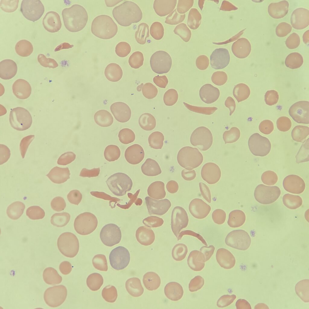 Sickle Cells, red blood cell morphology