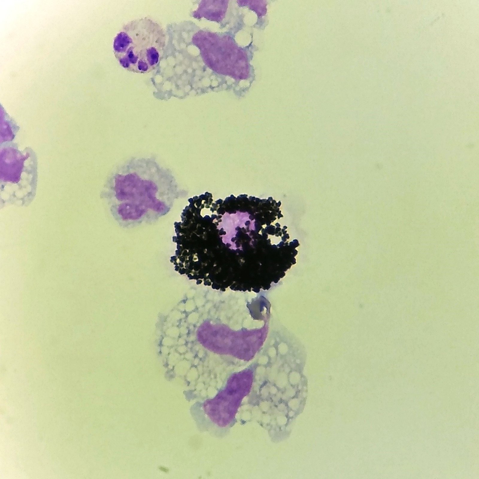 Siderophage: macrophage with coarse dark blue granules