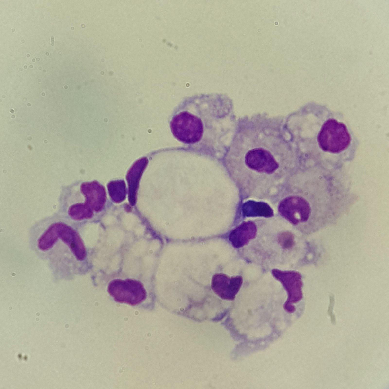 Signet Ring-like macrophage in Body Fluid