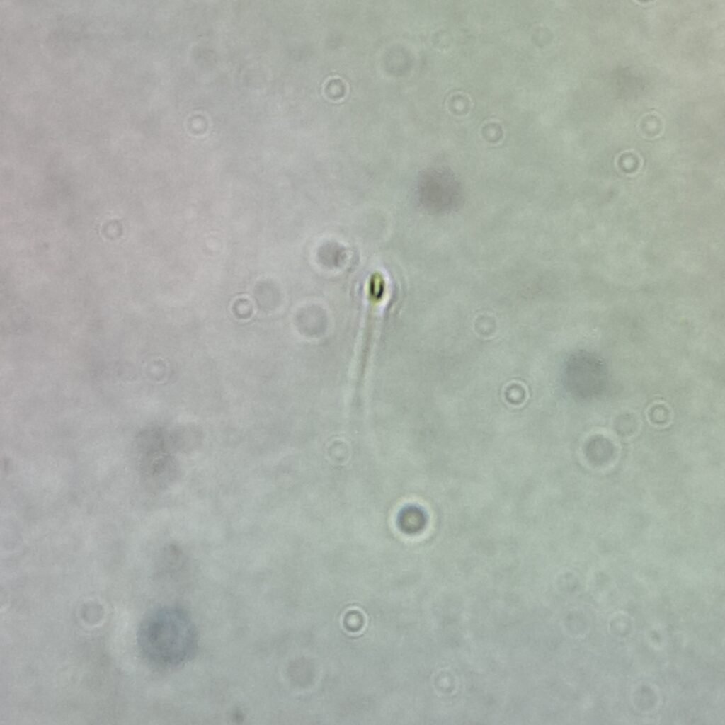 spermatozoa in urine