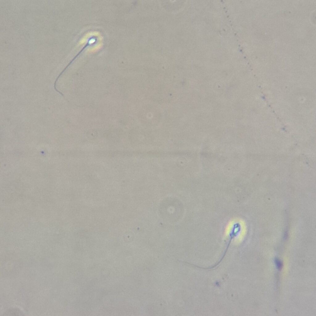 spermatozoa in urine