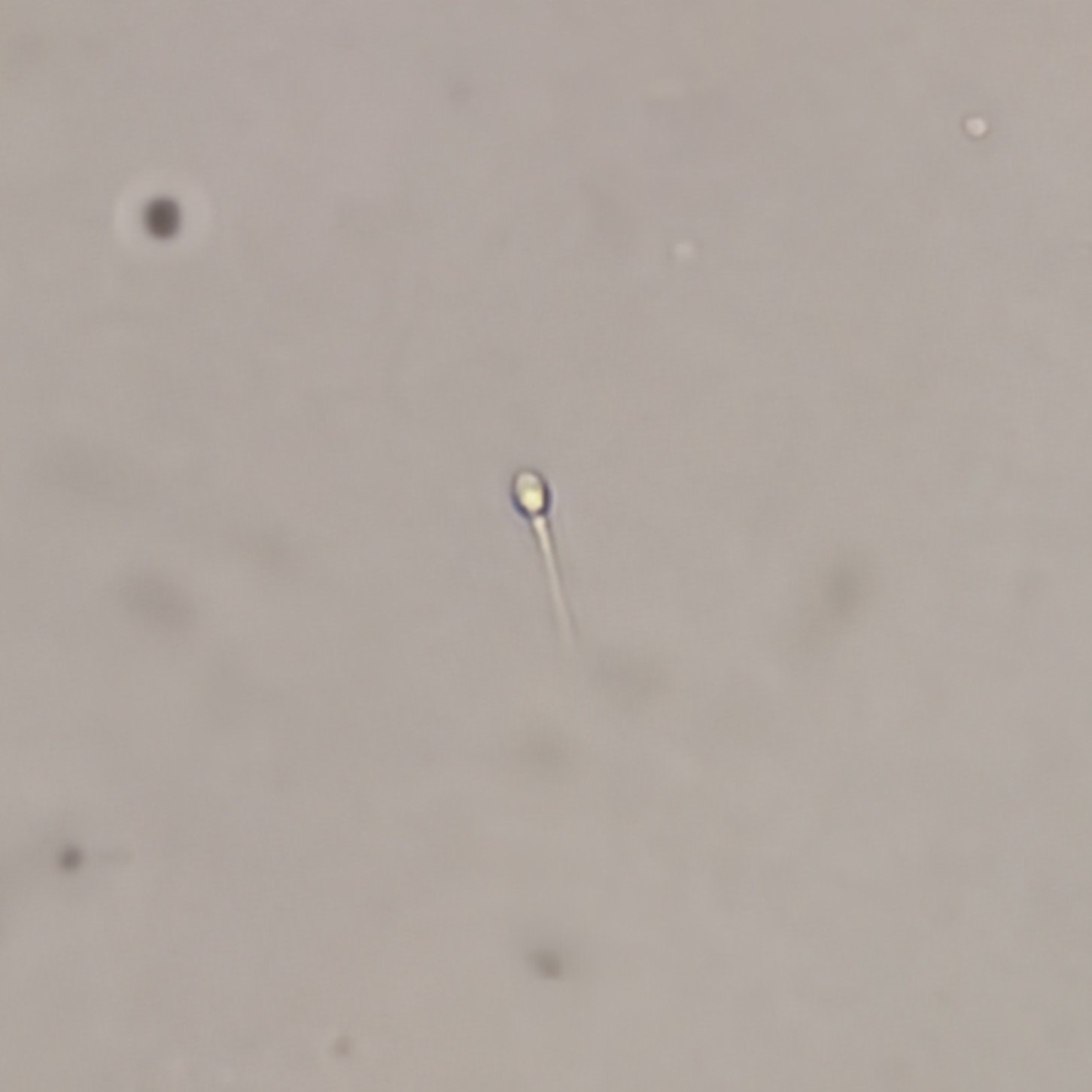 Spermatozoa in Urine Sediment