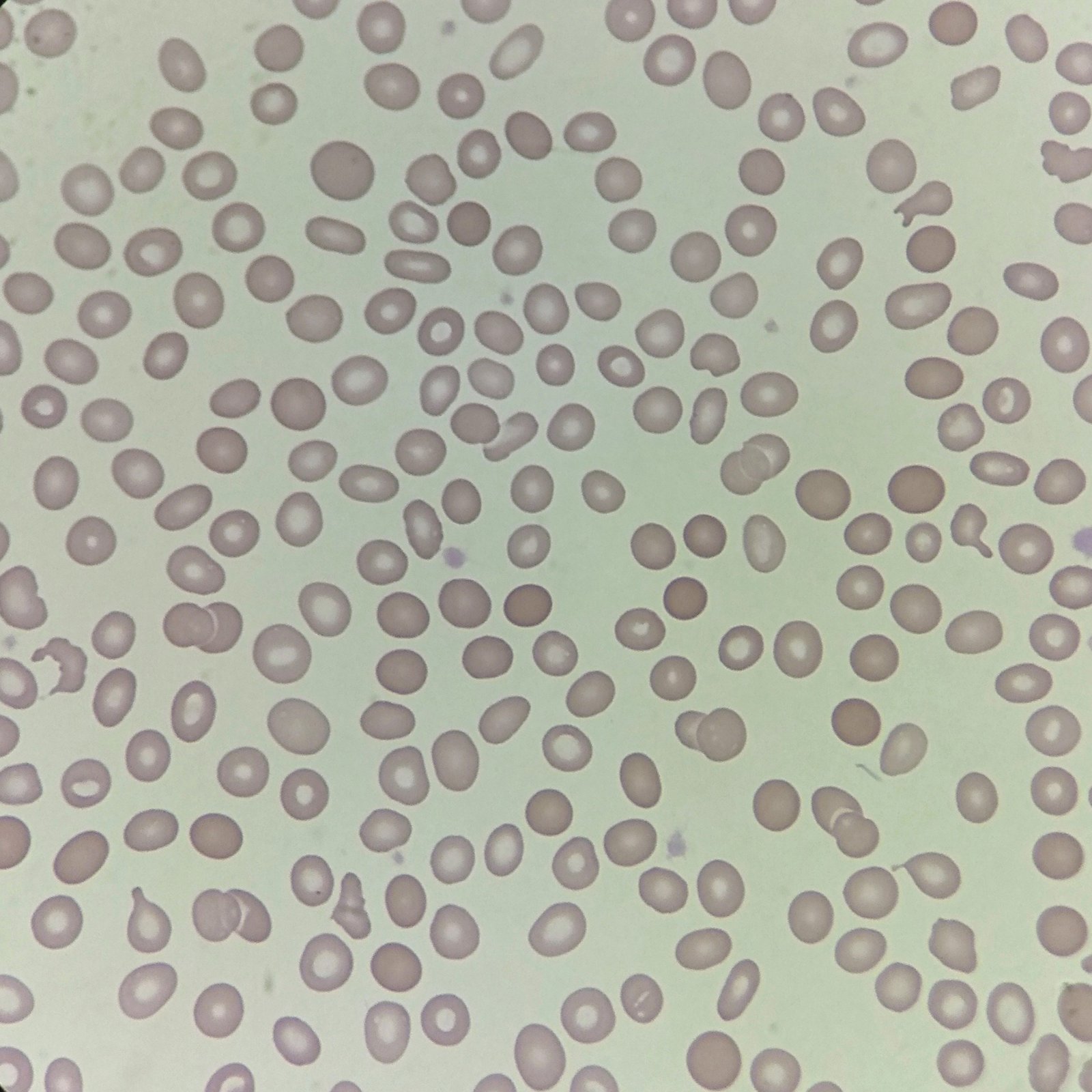 Spherocytes, red blood cell morphology