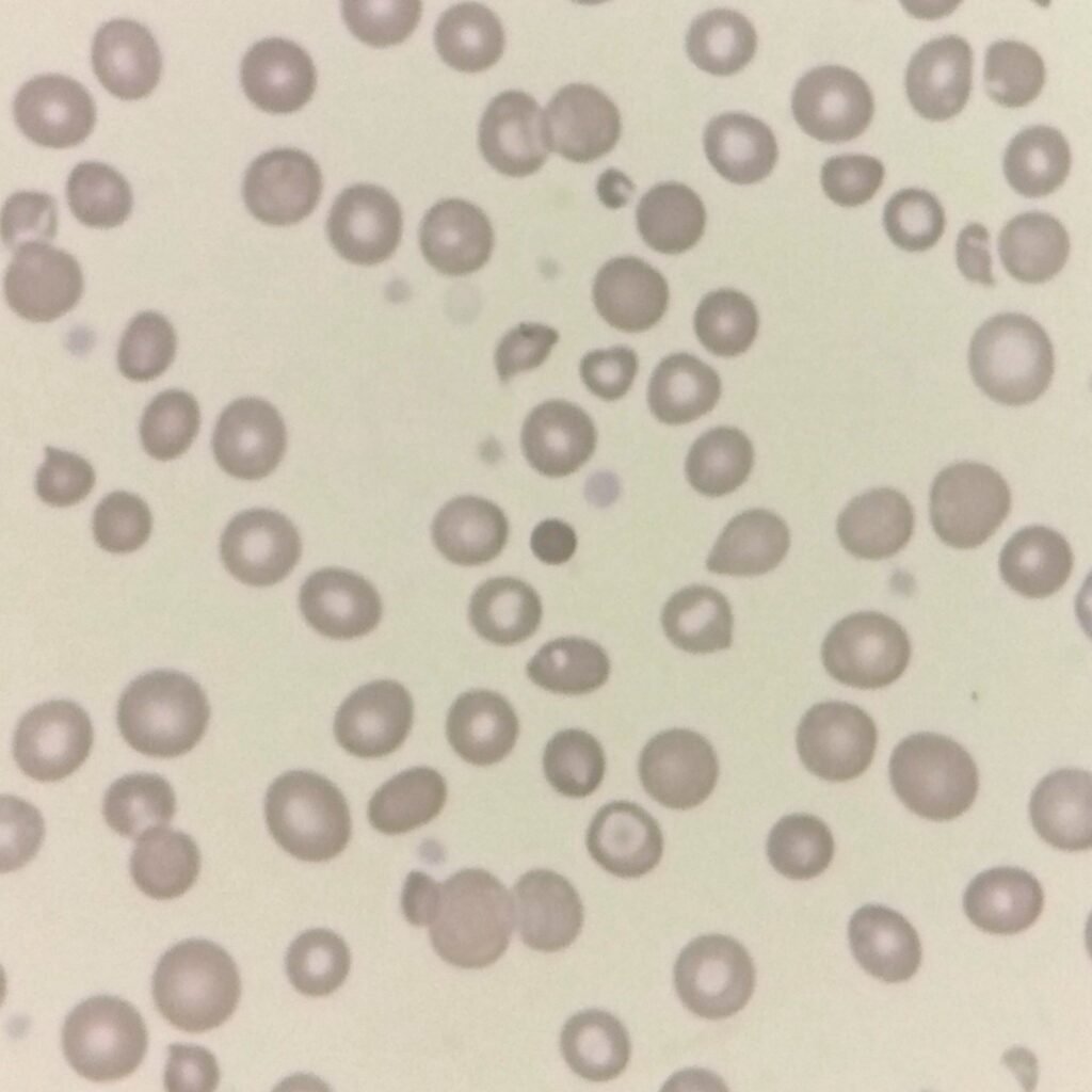 spherocytes