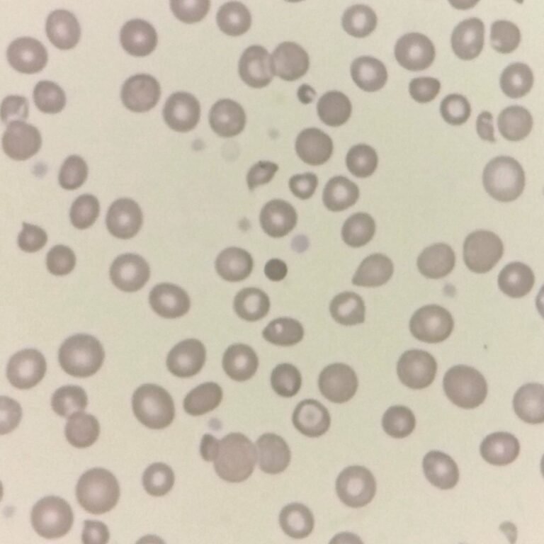 Spirocyte Rbc Spherocytes: Appearance & Clinical Significance - MedLabBuddy