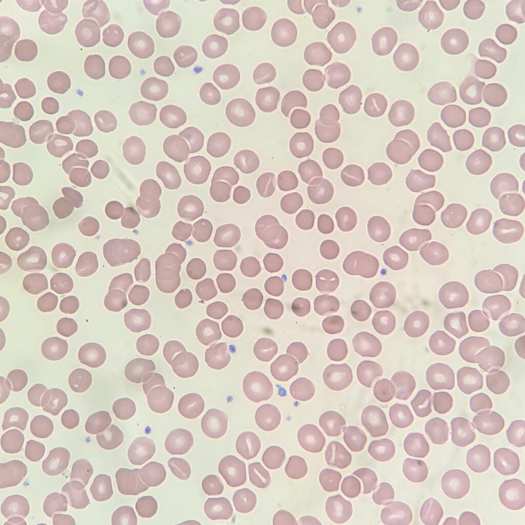 spherocytes in red blood cell morphology
