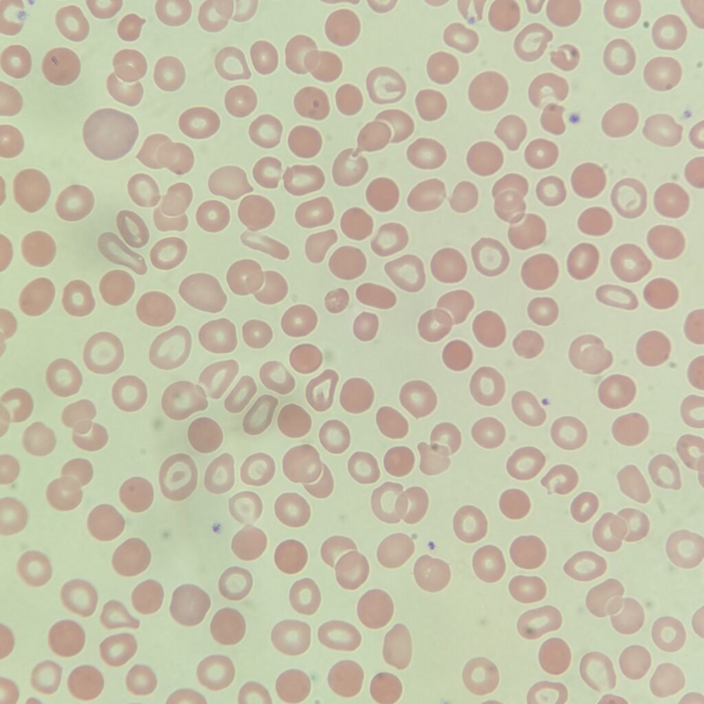 Spherocytes, red blood cell morphology