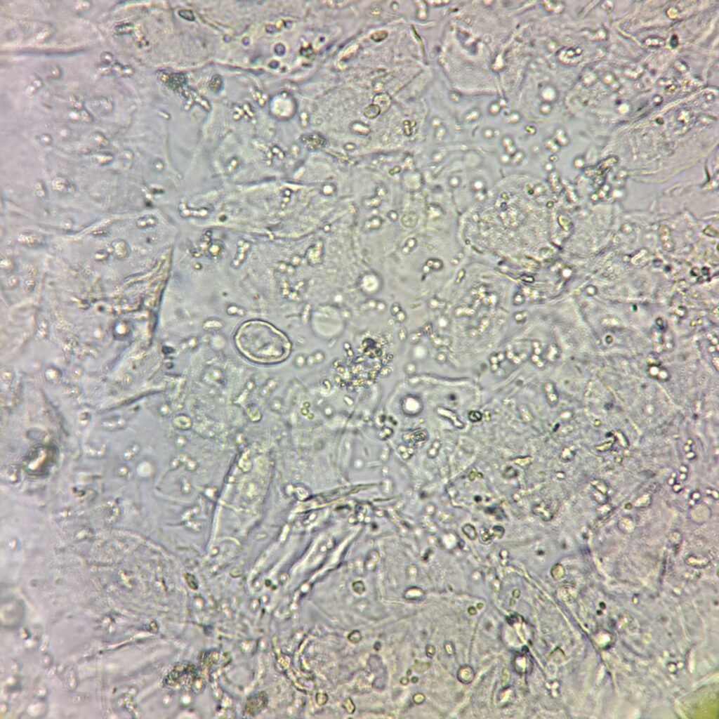 squamous epithelial cells in urine