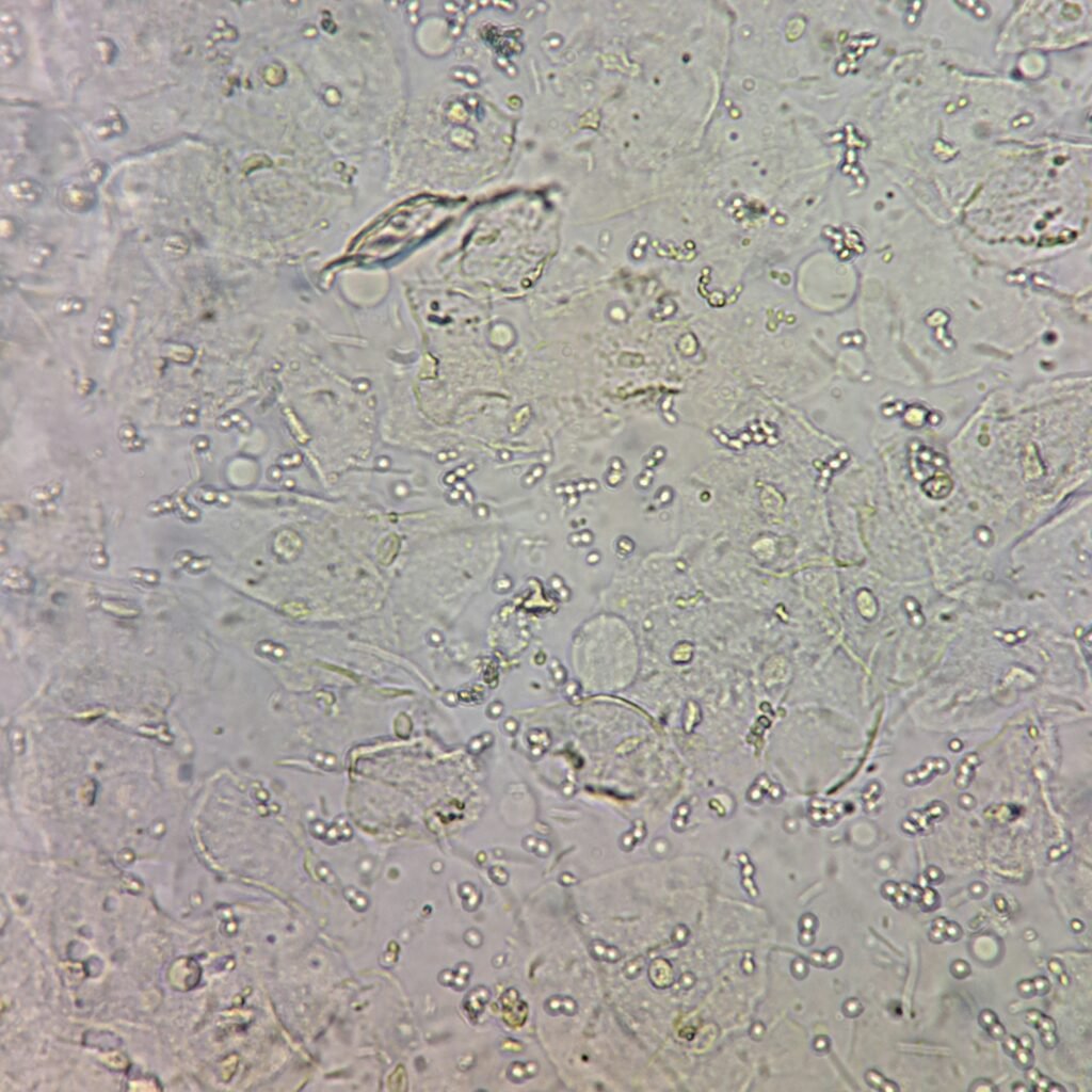 squamous epithelial cells in urine