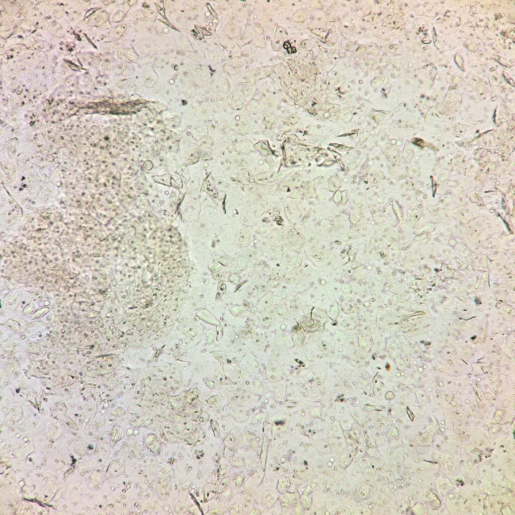 squamous epithelial cells in urine
