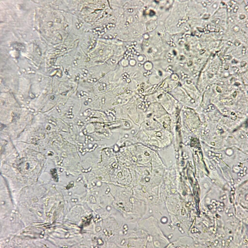 squamous epithelial cells in urine