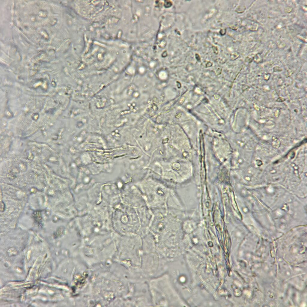 squamous epithelial cells in urine