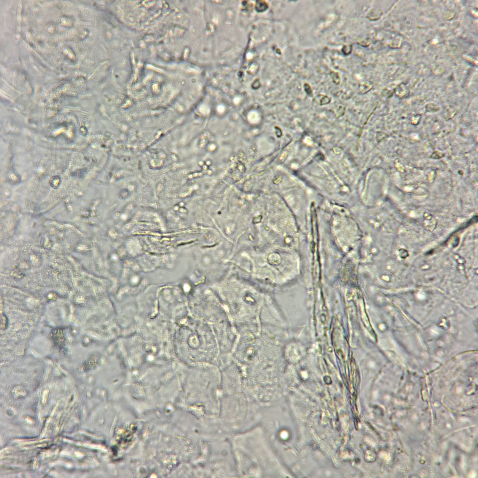 Transitional Epithelial Cells - MedLabBuddy