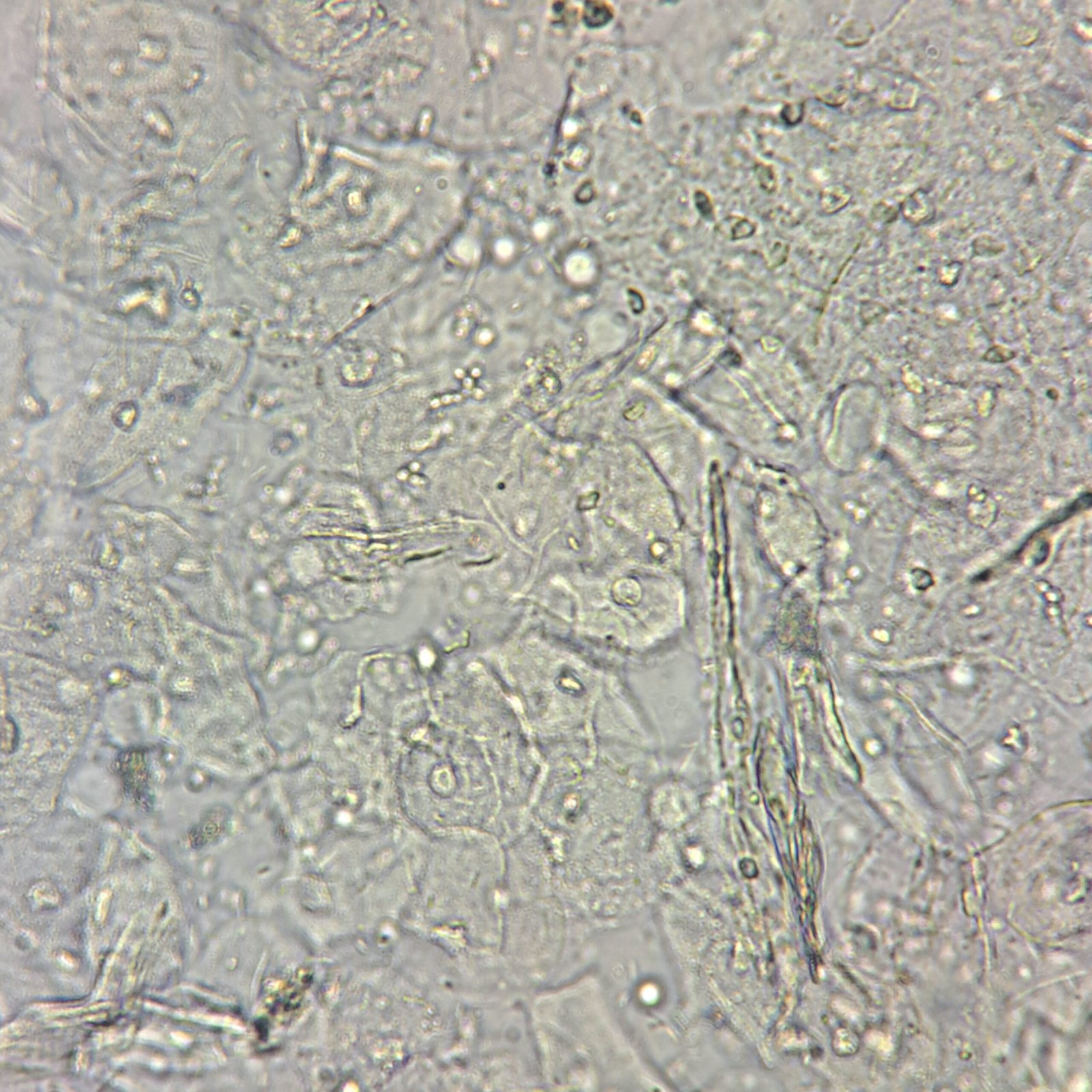 Squamous epithelial cells in urine