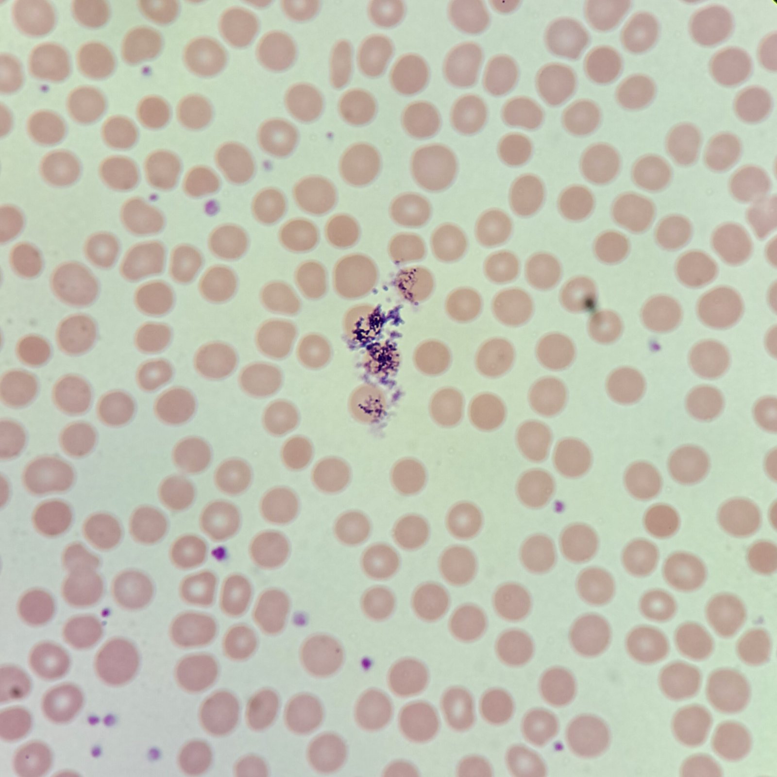 Stain precipitate artifact among red blood cells